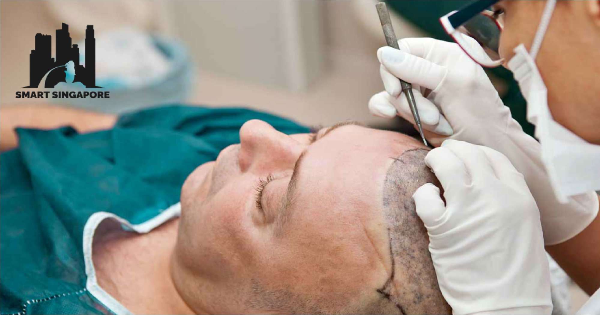Best Places for Hair Transplant
