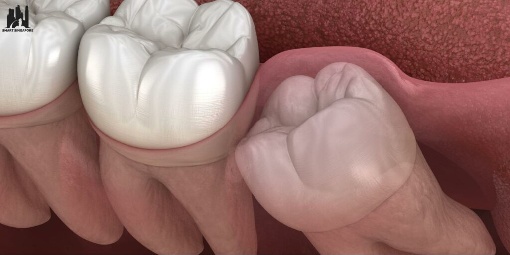 Why do we need to extract our wisdom teeth